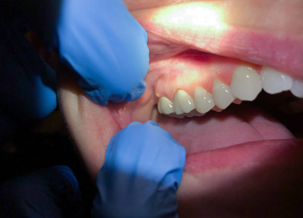 Best Emergency Denture Repair in Hicksville, NY