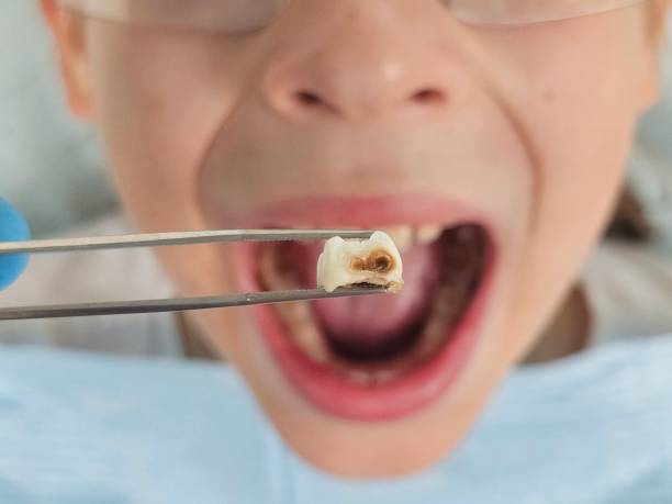 Best Emergency Treatment for Dental Infections or Abscesses in Hicksville, NY